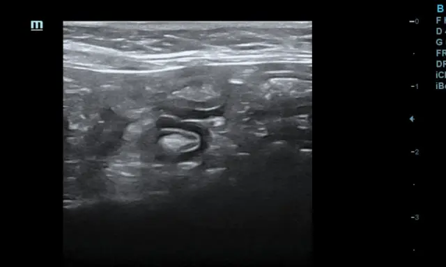 Obraz USG jelit kota z widocznymi zmianami sugerującymi ibd. Widoczna pogrubiona ściana jelita i utrata prawidłowej struktury.